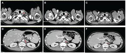 Case report: Microsatellite instability determination is not always black and white in Lynch syndrome diagnosis